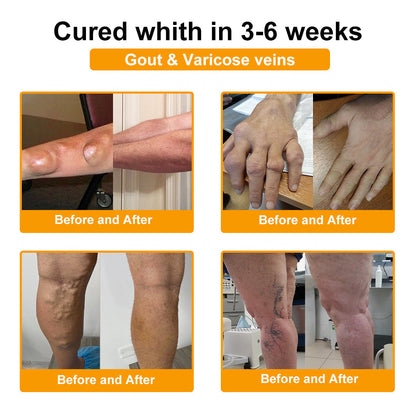 🎁Flash Sale - Ringmiz Botulinum Toxin & Bee Venom Pain-Relief Bone Healing Cream🐝💎