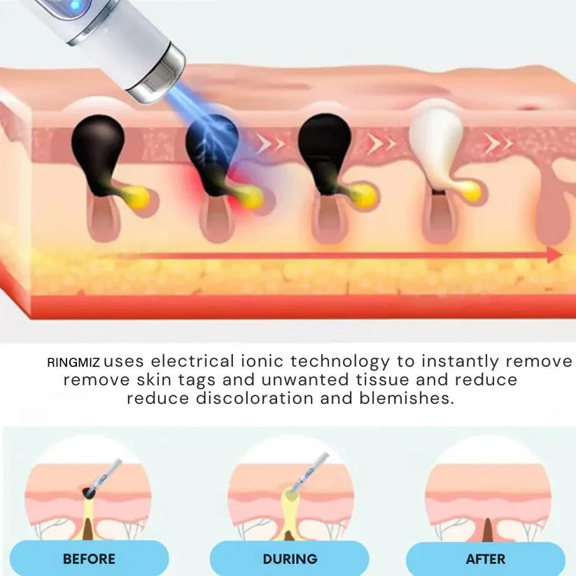 🔥【OFFICIAL STORE】Non-Invasive Mole and Wart Removal Laser Pen