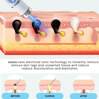 🔥【OFFICIAL STORE】Non-Invasive Mole and Wart Removal Laser Pen