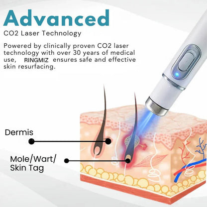🔥【OFFICIAL STORE】Non-Invasive Mole and Wart Removal Laser Pen