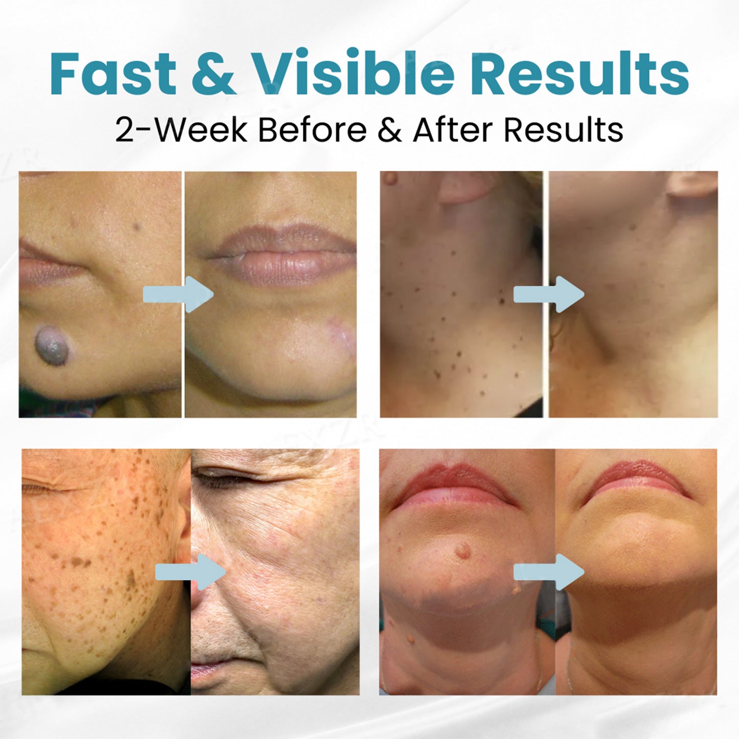 🔥【OFFICIAL STORE】Non-Invasive Mole and Wart Removal Laser Pen