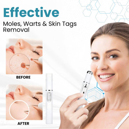 🔥【OFFICIAL STORE】Non-Invasive Mole and Wart Removal Laser Pen